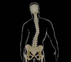  Adolescent Idiopathic Scoliosis 