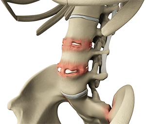 Ankylosing Spondylitis