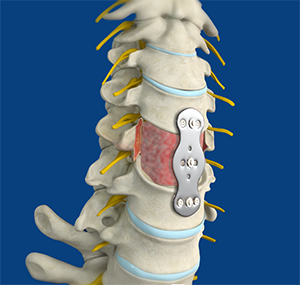 Anterior Cervical Corpectomy and Fusion