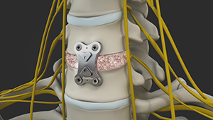 Anterior Cervical Discectomy with Fusion