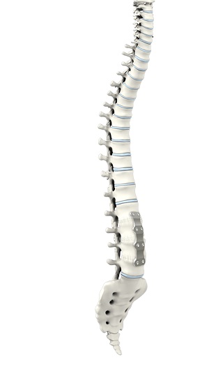 Anterior Lumbar Interbody Fusion