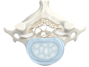 Cervical Degenerative Disorder