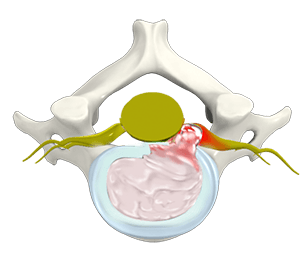 Cervical Disc Herniation