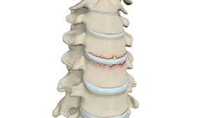  Cervical Fracture 