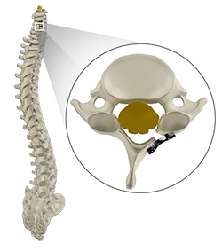 Cervical Laminoplasty