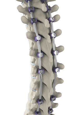 Complex Spinal Reconstruction