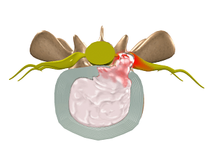  Disc Herniation 