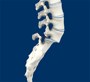  Isthmic Spondylolisthesis 