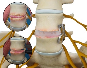 Lateral Lumbar Interbody Fusion