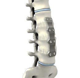 Lumbar Corpectomy and Fusion