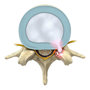 Lumbar Herniated Disc