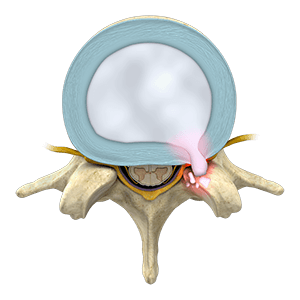   Lumbar Herniated Disc 