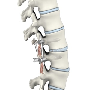 Minimally Invasive Lumbar Discectomy