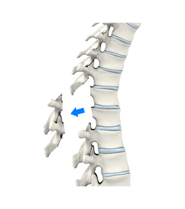 Lumbar Laminectomy