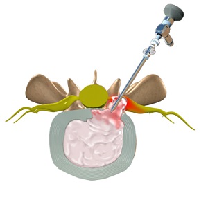 Lumbar Microdiscectomy