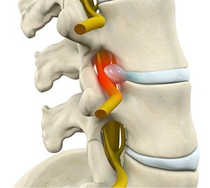  Lumbar Radiculopathy  