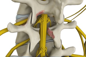 Minimally Invasive Lumbar Decompression