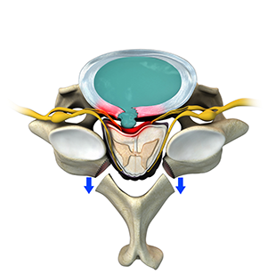 Posterior Cervical Laminectomy and Fusion