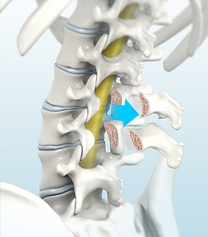 Posterior Lumbar Interbody Fusion