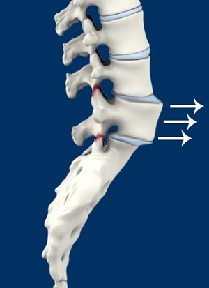  Spinal Instability  