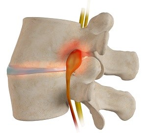  Spinal Stenosis  