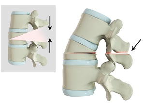 Spine Osteotomy