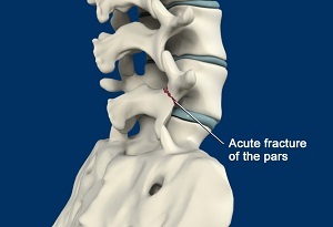  Spondylolysis  