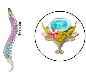  Thoracic Myelopathy  