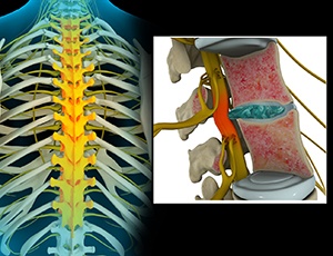  Thoracic Nerve Compression  