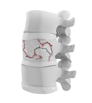 Thoracic Spine Trauma Surgery