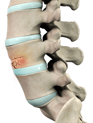 Vertebral Compression Fractures